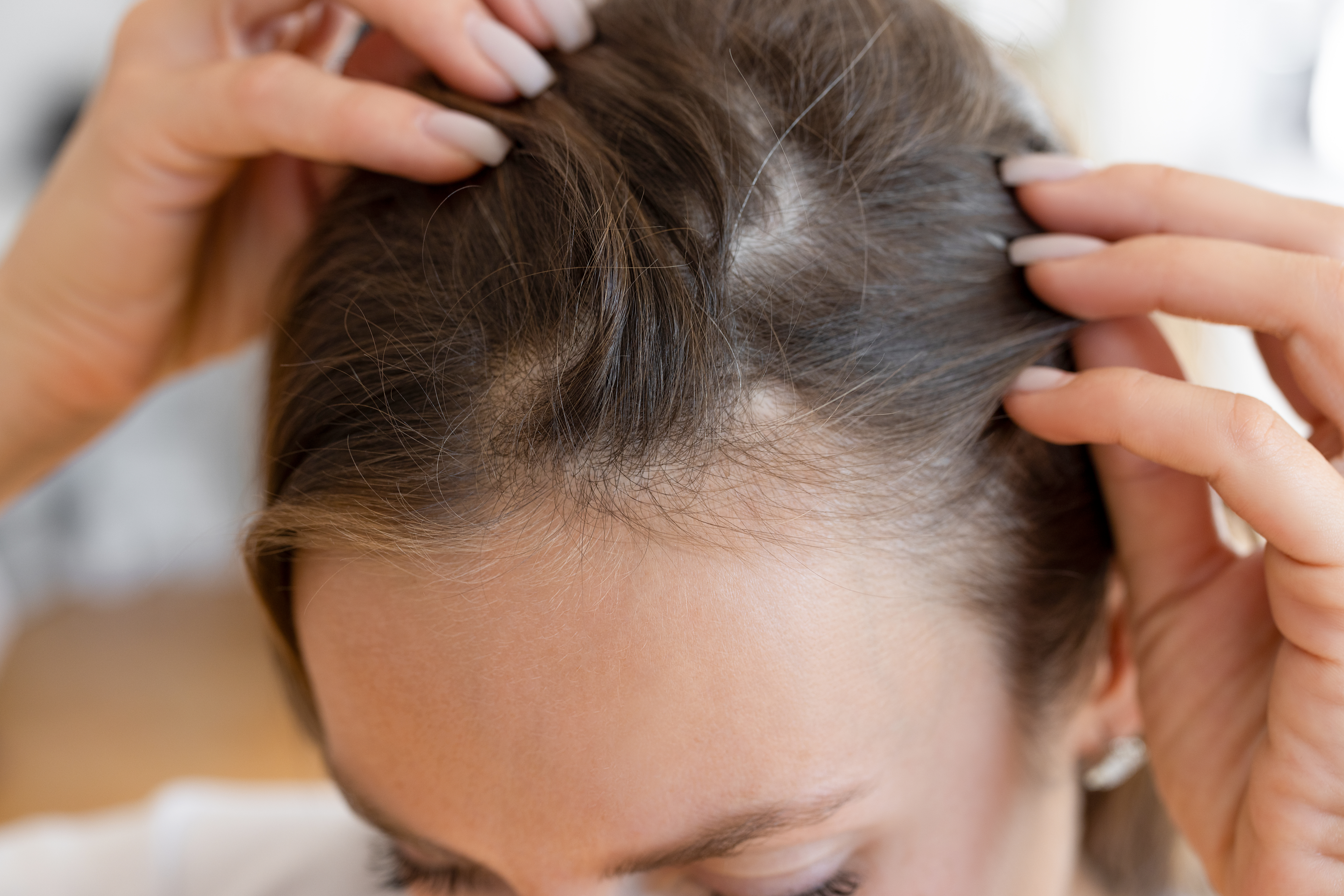 Chute de cheveux